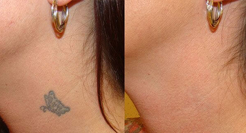 LASER TATTOO REMOVAL CAULFIED MELBOURNE